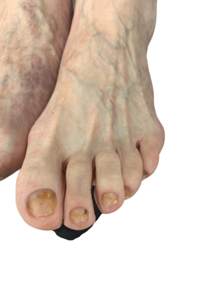 After Treatment